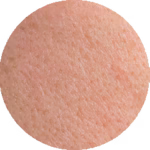 پوست چرب (Oily Skin)